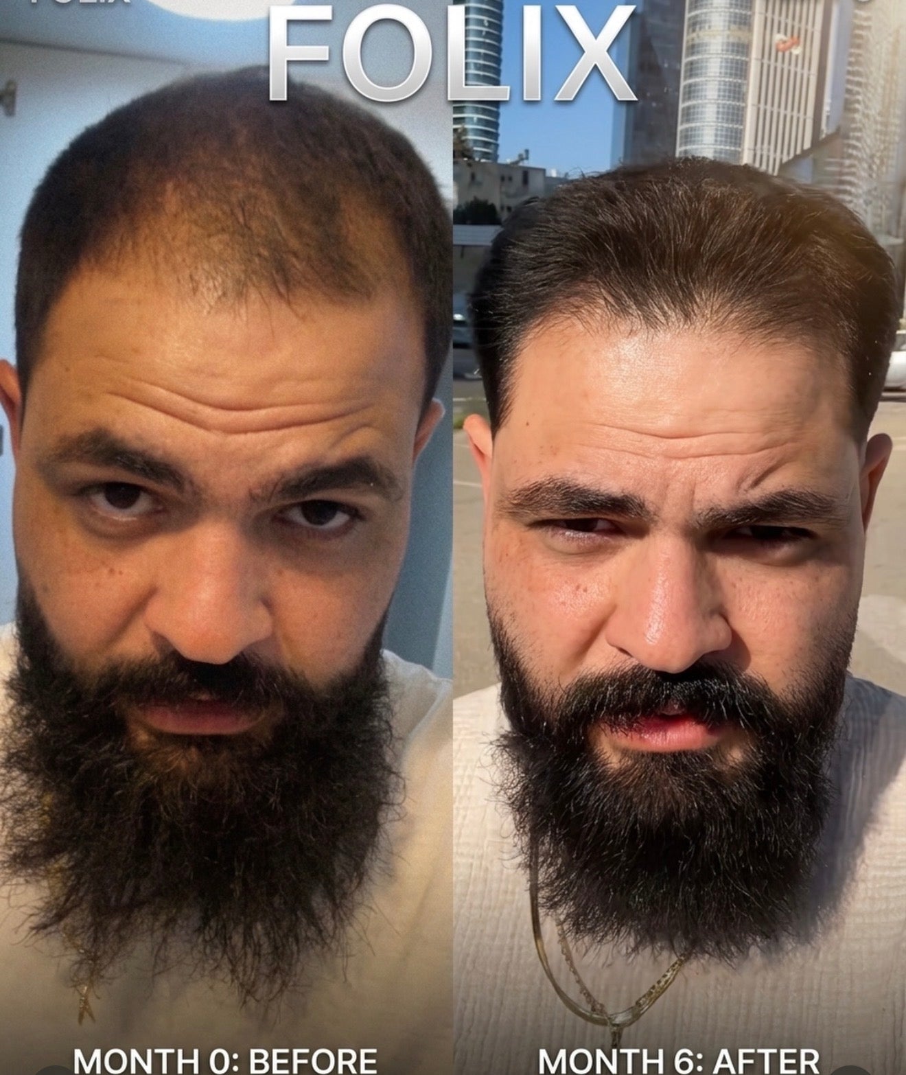 לקוח FOLIX לפני ואחרי שישה חודשים בקו השיער הקדמי