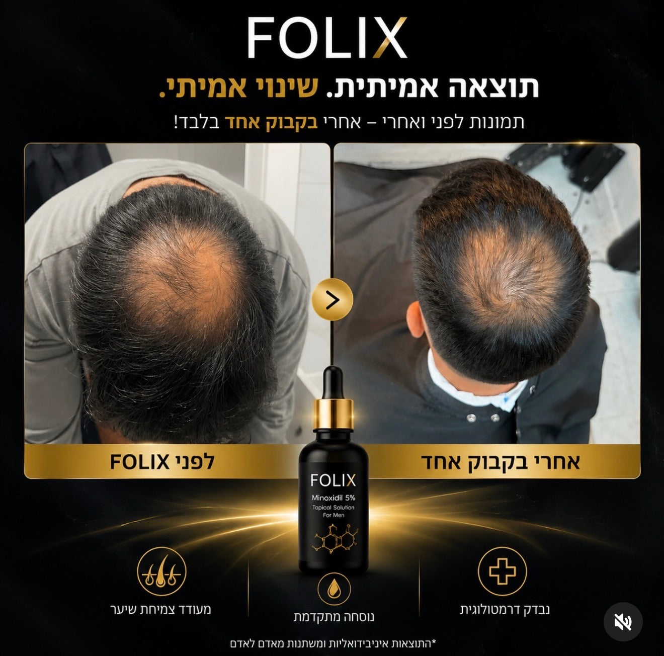 תמונת לפני ואחרי של לקוח FOLIX באזור הכתר